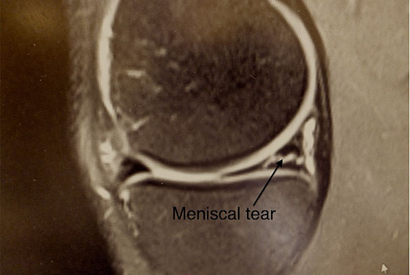 MRI image of meniscus tear -knee sports injuries consultant Mr Aslam Mohammed 25 years experience in treating meniscal tears in high level atheltics   knee injuries